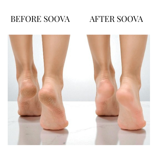 Soova™ SmoothPro Electric Callus Remover